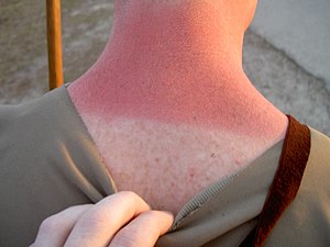 Sunburn_Treatment_Practices